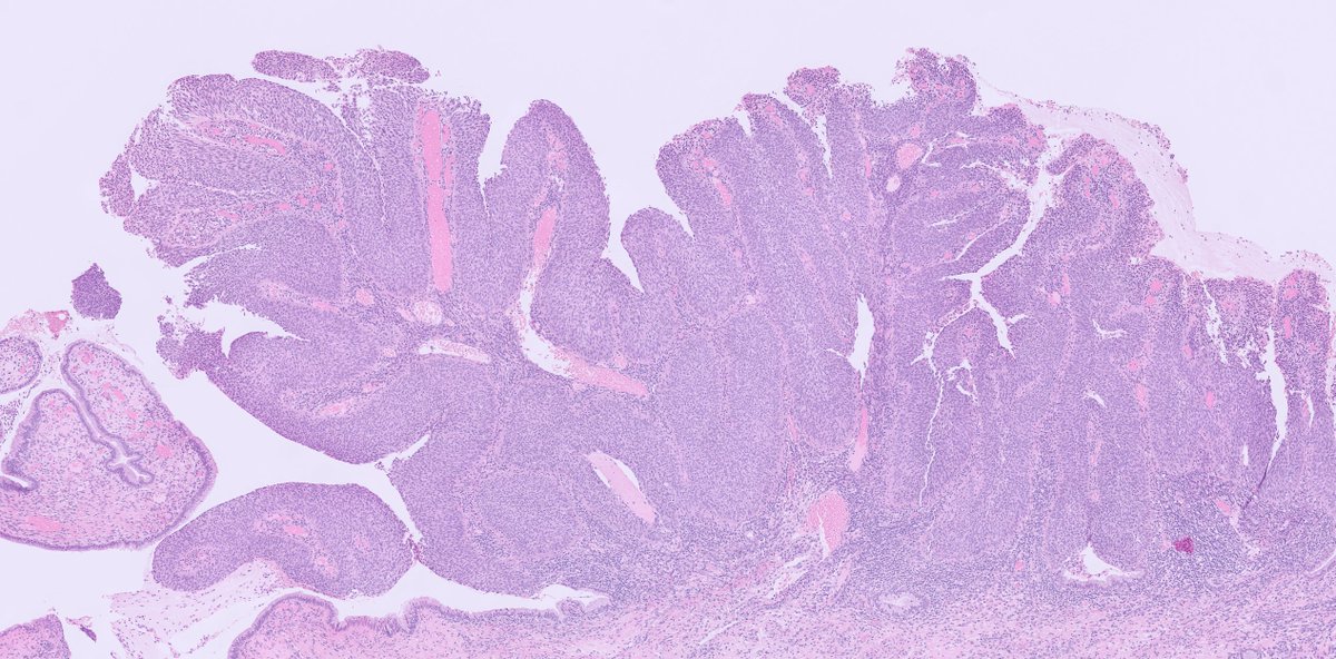 kis_lorand's tweet photo. Not an everydaily pattern of HSIL, this time in a cervical loop excision specimen 👇👇👇
#gynpath #pathology #PathTwitter https://t.co/IgE39fC2vp