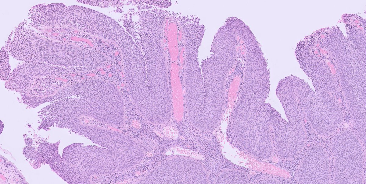 kis_lorand's tweet photo. Not an everydaily pattern of HSIL, this time in a cervical loop excision specimen 👇👇👇
#gynpath #pathology #PathTwitter https://t.co/IgE39fC2vp