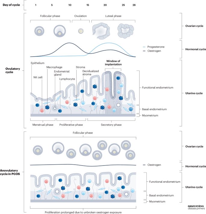 In women with #PCOS and irregular cycles, the endometrium is exposed to #oestrogen without counteracting #progesterone action. @DiseasePrimers #MedEd #MedX nature.com/articles/s4157…