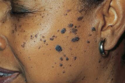 📌SEBORRHEIC KERATOSIS A harmless skin condition caused by accumulation of dead skin cells, forming colored bumps on the skin. Increases with age, excess sunshine exposure, ladies on hormone therapy, pregnant ones, and people with similar ‘rashes’ in their family tree.