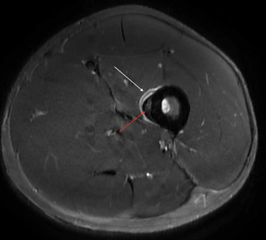 Consent ✅

High level 1500m runner

Weekly volumes increasing 

Runing on beach / hilly terrain on holiday

Increasing L quad (medial mainly) pain - 'bruised' feeling (thought was due to foam rolling)

Then increasing sharp pain, even on walking

Hop test +ive
Resisted quads