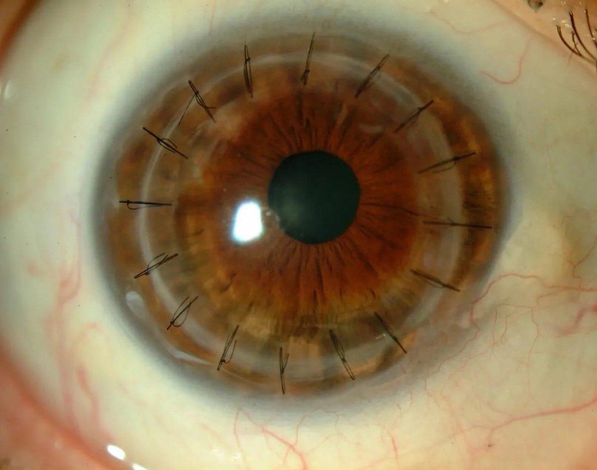 Un ojo con suturas de un trasplante de córnea muestra puntos finos y delicados. La cirugía, que dura menos de una hora, implica reemplazar el tejido corneal dañado del paciente con uno sano de un donante.