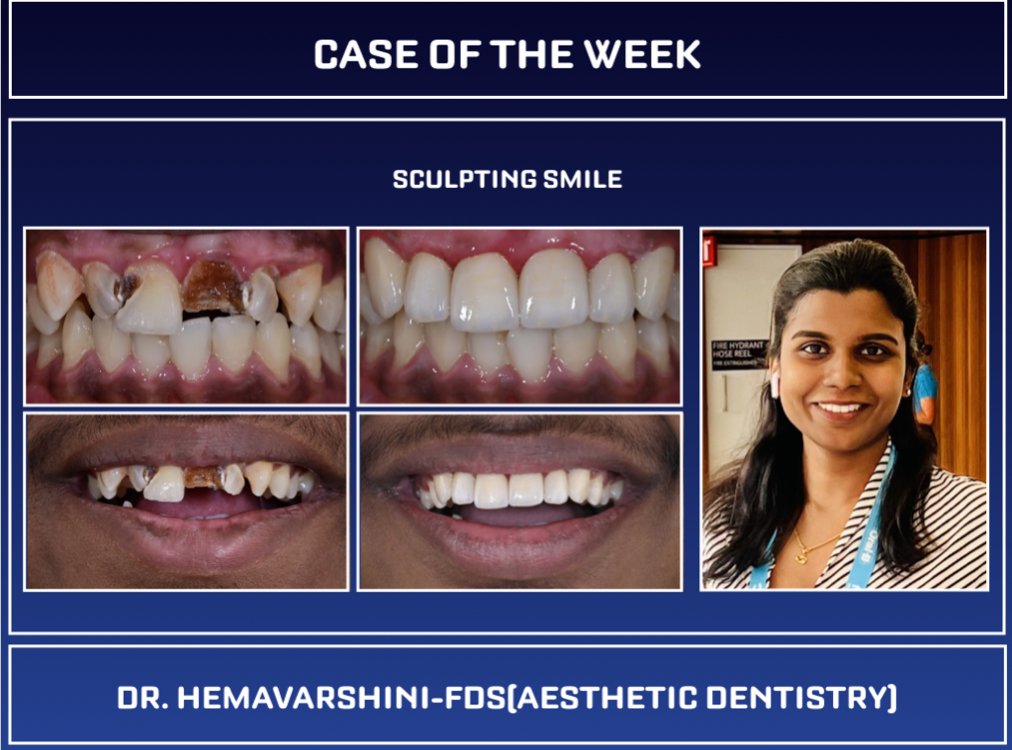 Case of the week #dentistry #dentist #esthetics #whitesmiles #Smiles