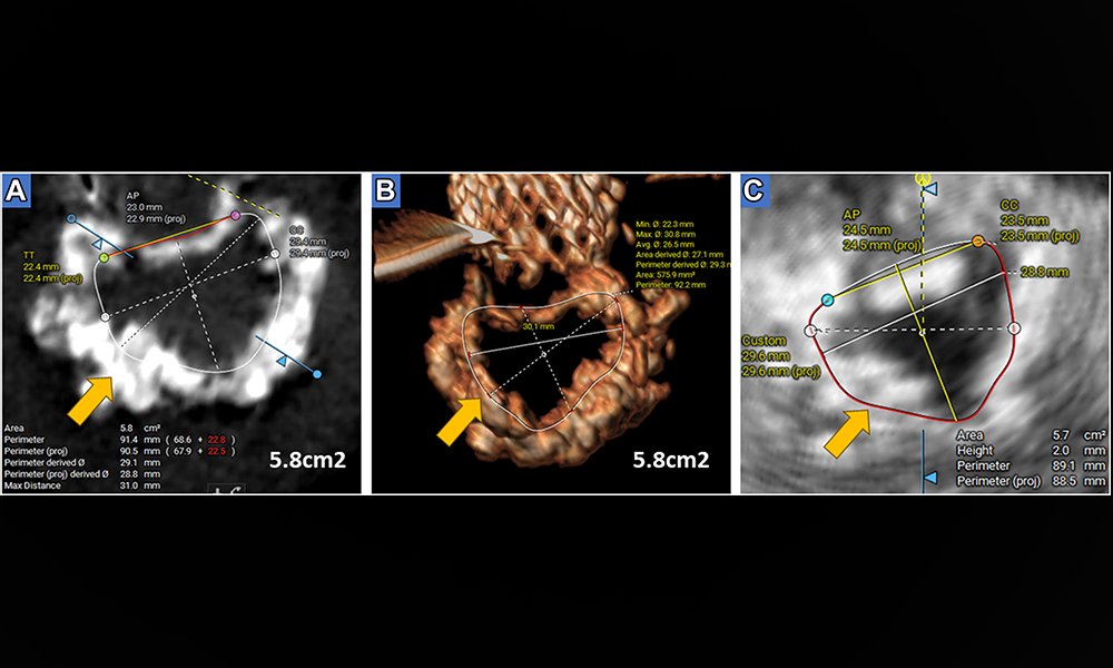 This @CASEfromASE report demonstrates the use of a novel echocardiographic software as an alternative to contrast-enhanced CCT for preprocedural valve-in-MAC screening and outlines technical considerations aimed at mitigating the risk of LVOTO. Read it: bit.ly/3xEu1ij