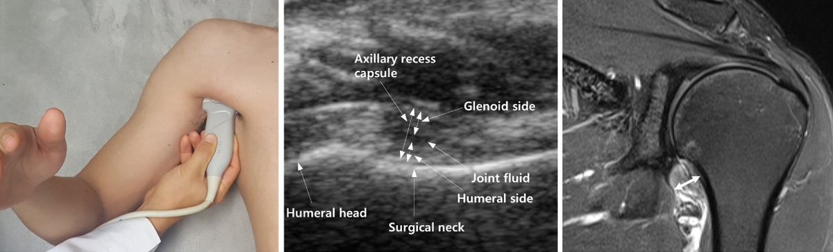 Ultrasound measurements of axillary recess capsule thickness in unilateral frozen shoulder: study of correlation with MRI measurements FREE PDF link.springer.com/content/pdf/10…