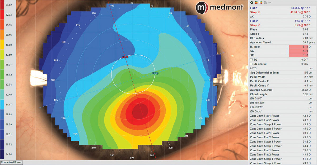 Corneal Topography: Get to New Heights

In the latest issue of Review of Cornea & Contact Lenses, see how elevation data reveals the greatest truths about corneo-scleral shape. Read here: reviewofcontactlenses.com/article/cornea…
#optometry #cornea #eyecare #contactlens