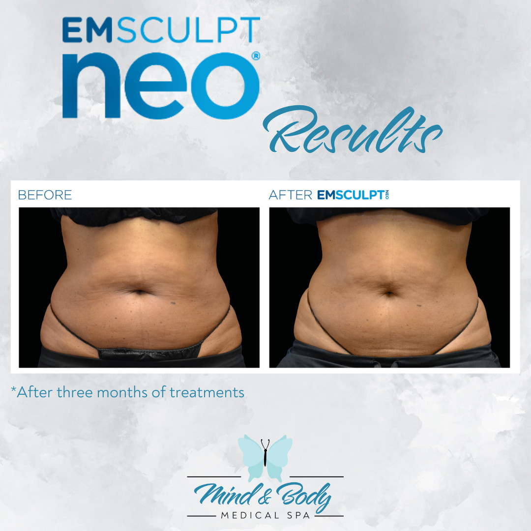 EMSCULPT NEO at Mind & Body Medical Spa is an advanced treatment that permanently damages fat cells while building muscle tissue. High-intensity electromagnetic therapy and radiofrequency thermal energy stimulate muscle contractions at a rate equivalent to 10,000 contractions.