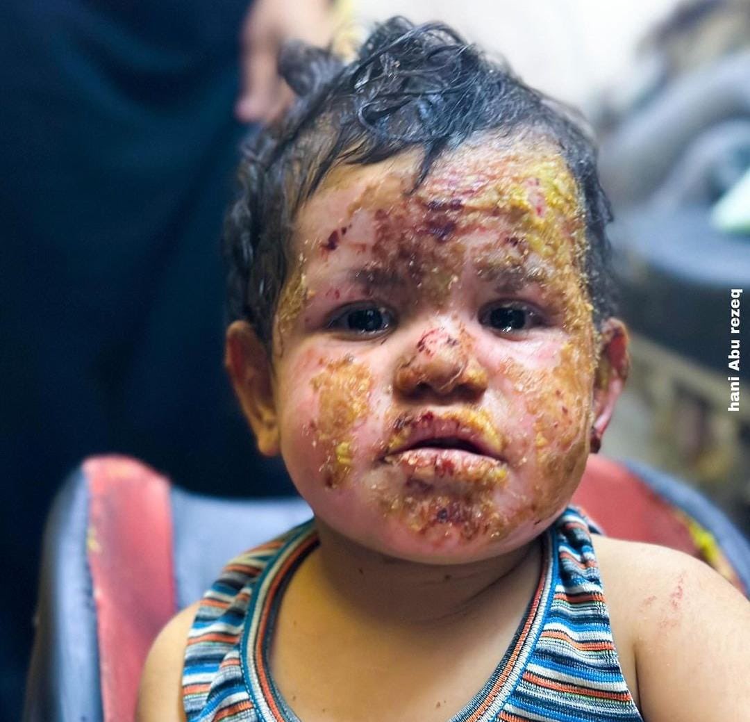 Palestinian girl Qamar and her mother sustained severe burns in their bodies due to a gas cylinder explosion inside their home after a neighboring house was bombed in Al-Bureij refugee camp.