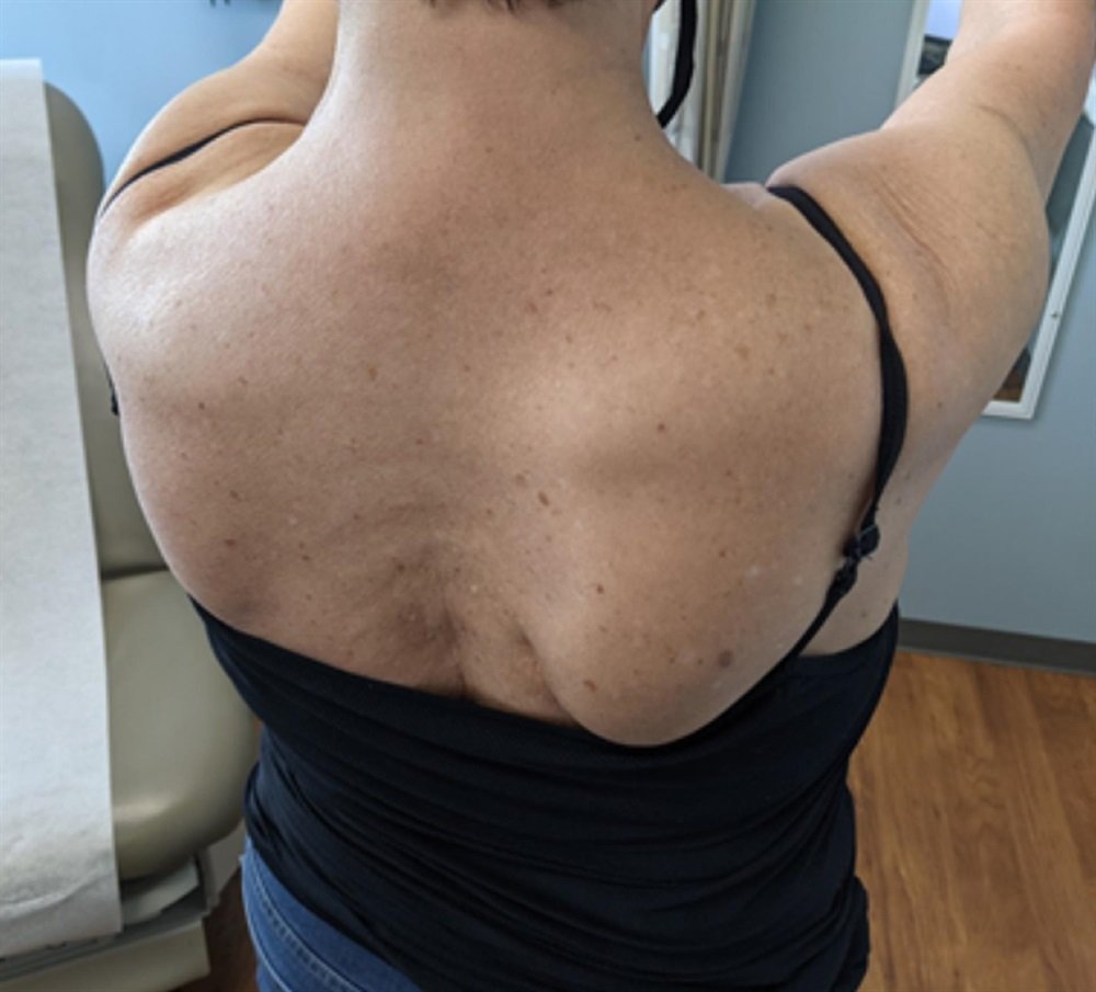 We report the case of a 66-year-old woman with right shoulder dysfunction and medial scapular winging after immunization with the #Pfizer BNT162b2  #mRNA vaccine.
journals.lww.com/jbjscc/abstrac…