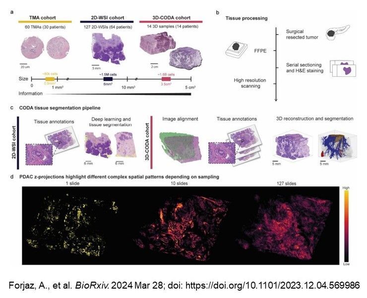 In a study funded by #CCBIR, @andreforjaz, @AshleyKiemen, @deniswirtz, et al. showed that 3D assessments are necessary to accurately assess the composition of tissues @biorxivpreprint biorxiv.org/content/10.110….