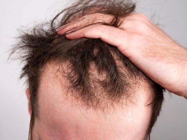 Men in my age are losing hair rapidly. Some start balding early in their 20s.

All of them are doing at least few of the things below, which all contribute to hair loss:

- Poor diet without animal fats (vegan)
- Blue light exposure (lack of sunlight)
- Excessive masturbation
-