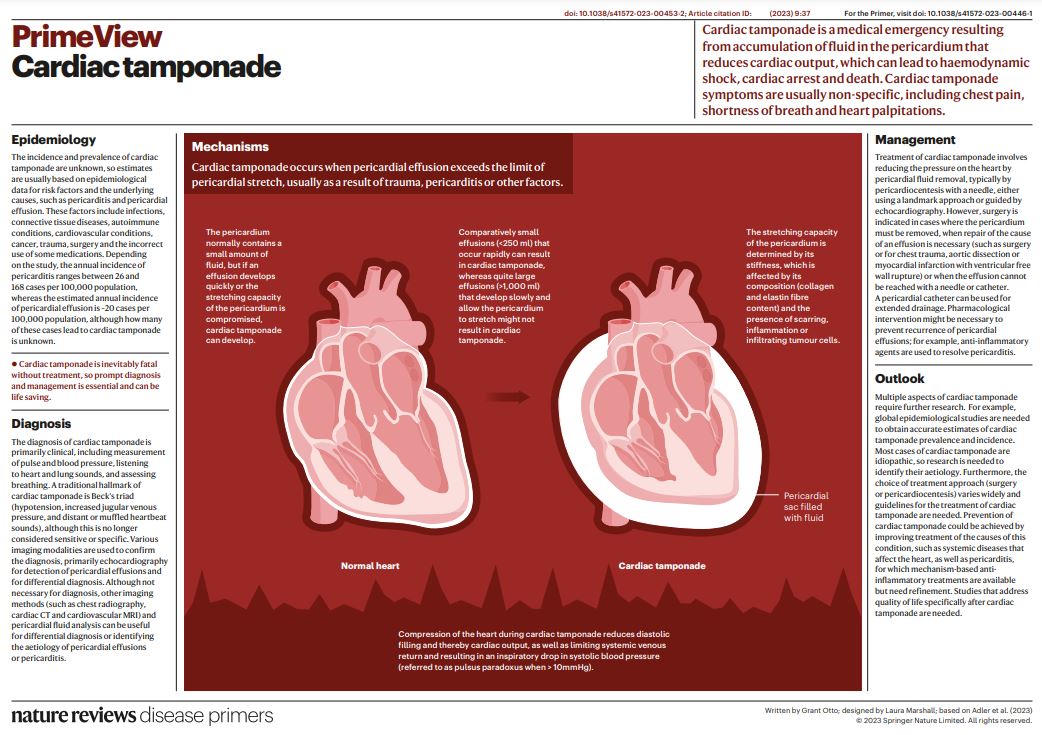 Cardiac tamponade is a potentially life-threatening emergency involving compression of the heart caused by accumulation of fluid in the pericardial sac. go.nature.com/3DnyCoG
