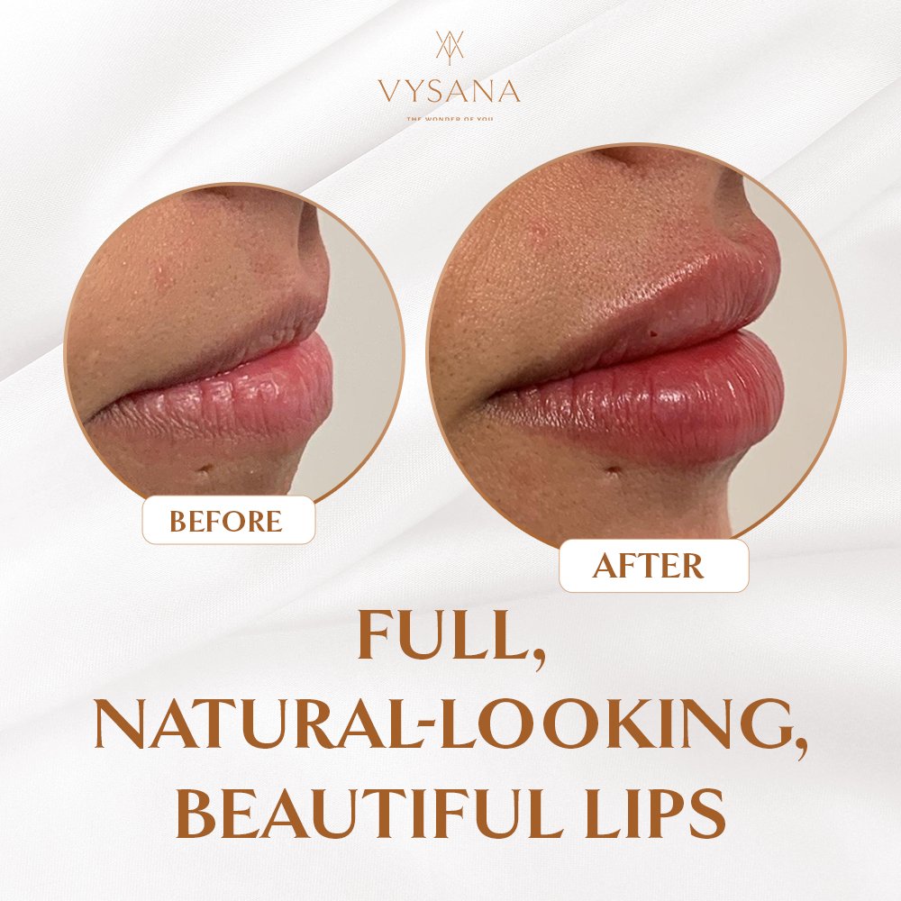 Kiss those lines goodbye with Vysana Lip Fillers.

Book your consultation now ⤵️
vysana.com/dermal-fillers… 

Everyone will notice, no one will know!

#lipfillers #lips #fillers #dermalfillers #lipinjections #beauty #aesthetics #lipfiller