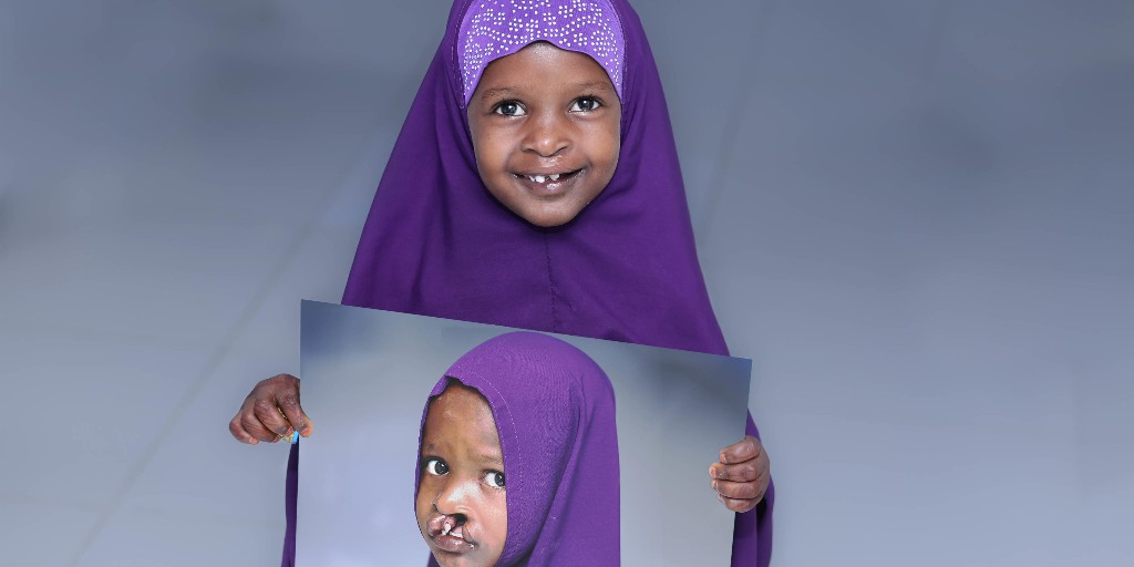 Smile Train empowers local medical professionals to provide free cleft surgeries, improving lives and easing financial burden on caregivers for patients like Maimun from Somalia. Our goal for the past 25-years: promote healthy smiles for stronger families and communities.