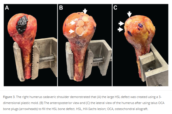 Fill that Hill-Sachs defect! This cadaveric study from @SPRI shows talar osteochondral allograft plugs can restore congruency. #shoulderinstability #latrajet #bankart #shoulderarthroscopy #OrthoTwitter Read the full study #OpenAccess here! ow.ly/pwMx50RhCCa