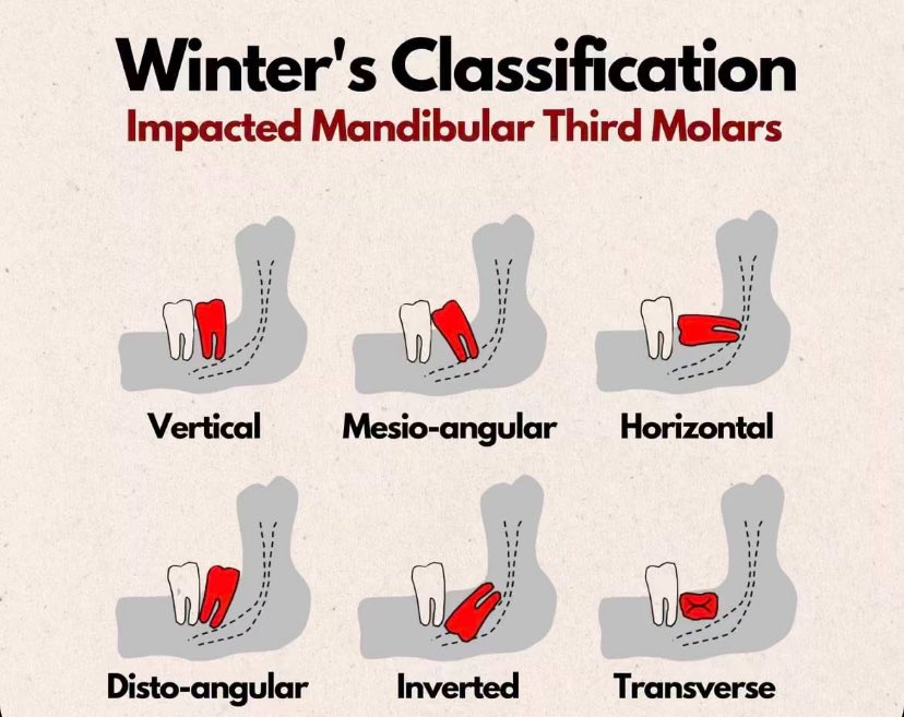 💡| Winter’s Classification 🦷