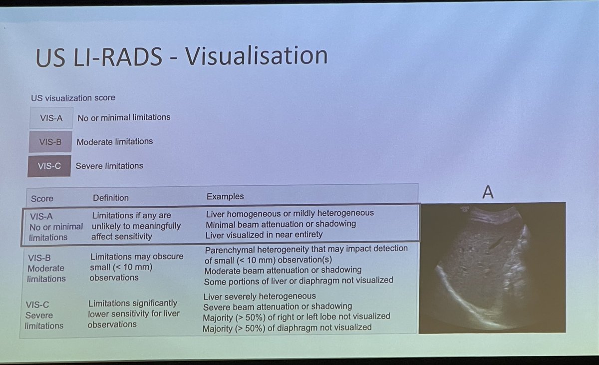 Almo0ou's tweet photo. Excellent talk at #BASL Monothematic meeting: Improving surveillance for hepatocellular carcinoma in the UK by @JamesMFranklin on improving surveillance delivery. Adoption of standardised reporting using US LI-RADS might be the key ! https://t.co/0ajHzWlovI