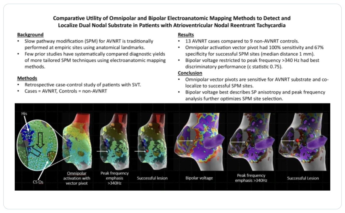 🚨New #FreeRead Article in @JICE_EP

Comparative Utility of Omnipolar & Bipolar Electroanatomic Mapping Methods to Detect & Localize Dual Nodal Substrate in Pts with AVNRT

🧐📖 rdcu.be/dFqaQ

by Edward T. O’Leary, @DavisSneider, Robert Przybylski, Audrey Dionne, Mark