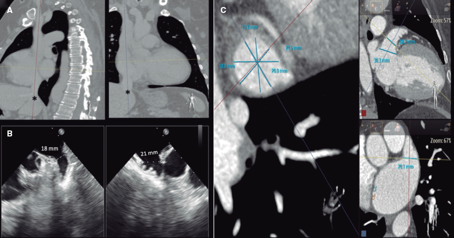 Cierre percutáneo transyugular de orejuela auricular izquierda #recintervcardiol  @JGCorSO @JimenezChechu recintervcardiol.org/es/imagenes-en…