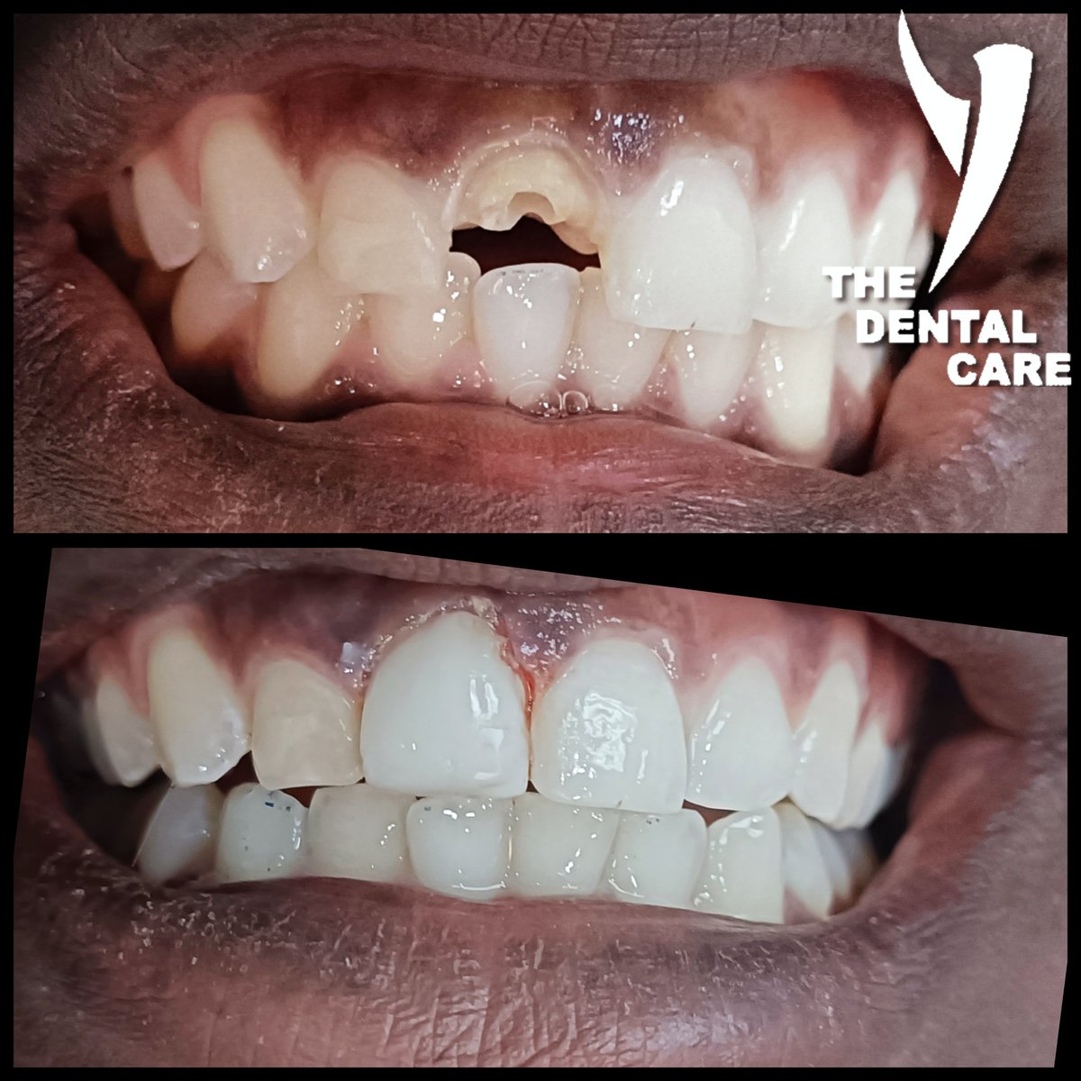 'Bring back your smile with our professional dental care! 😁✨ Schedule an appointment today and let us help you achieve your perfect smile! #dentalcare #smile #oralhealth'sekodental.co.za