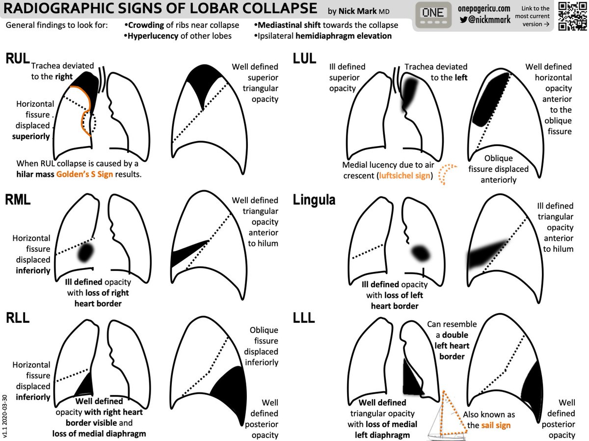 Lots of great ICU OnePager content featured in this episode including:
- approach to massive hemoptysis
- tracheostomy emegencies
- lobar collapse

If you like podcasts and ICU OnePagers you should check this out: