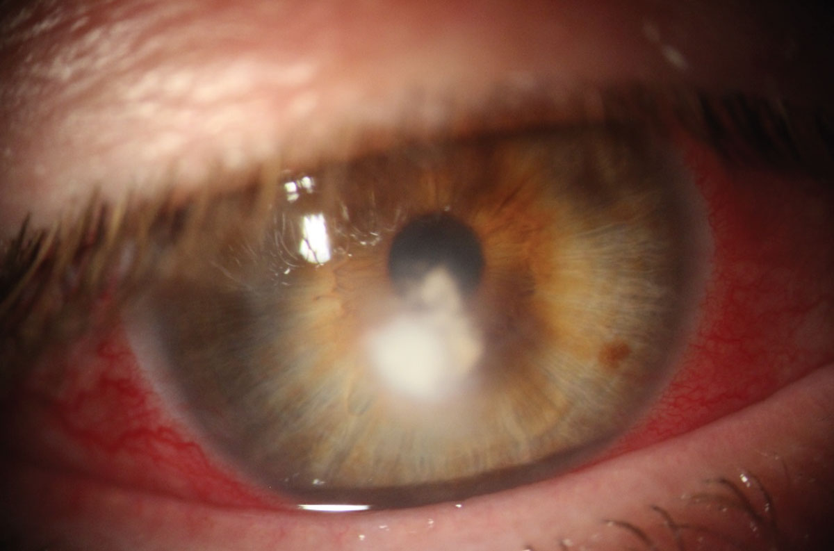 Twenty-year Study on Corneal Fungal Infections Shows Shifting Patterns

Candida, Aspergillus & Fusarium were the most common organisms. Filamentous keratitis had different risk factors, better outcomes & reduced need for surgery vs. yeast keratitis.
reviewofoptometry.com/article/twenty…