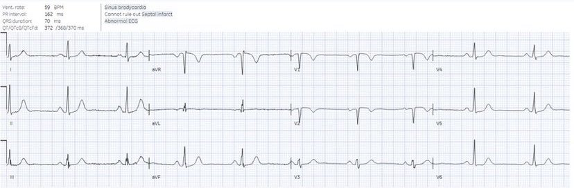 60 year old with episode of chest pain. What do you think? 
#ECG #EKG #FOAMed #MedEd #ECGinterpretation #medicalstudent #resident #Paramedic #nurse #EmergencyMedicine #CardioTwitter