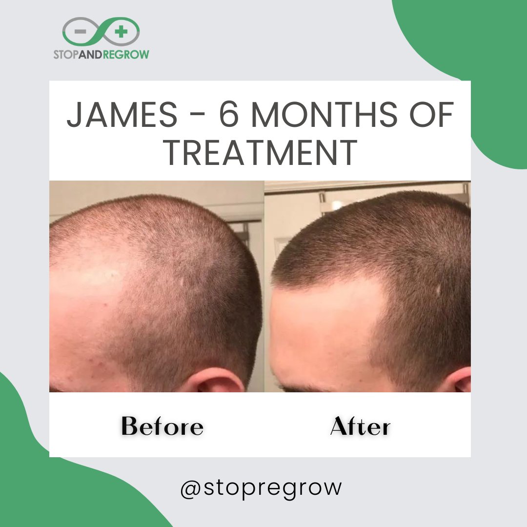Our Client James on his 6 months treatment of stop and regrow ✅

Learn More👉👉 stopandregrow.com

#hairgrowth #hair #hairloss #hairstyle #haircut #haircolor #hairstylist #hairstyles #longhair #hairdoctor #blonde #instahair #hairfashion #regrow #dna #hairgrowth