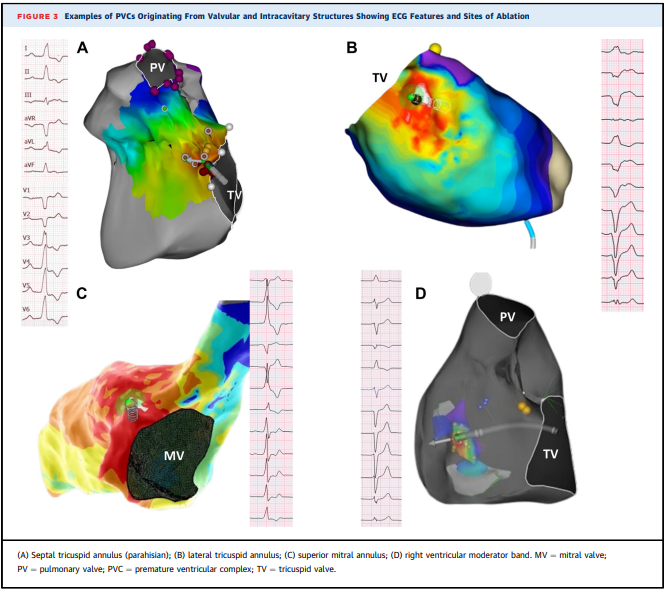 Bravo to @andresenriqueza for this excellent review of PVC ablation @JACCJournals! A must read for all #EPeeps. @DrFerminGarcia Daniel Muser @PennEPFellows sciencedirect.com/science/articl…