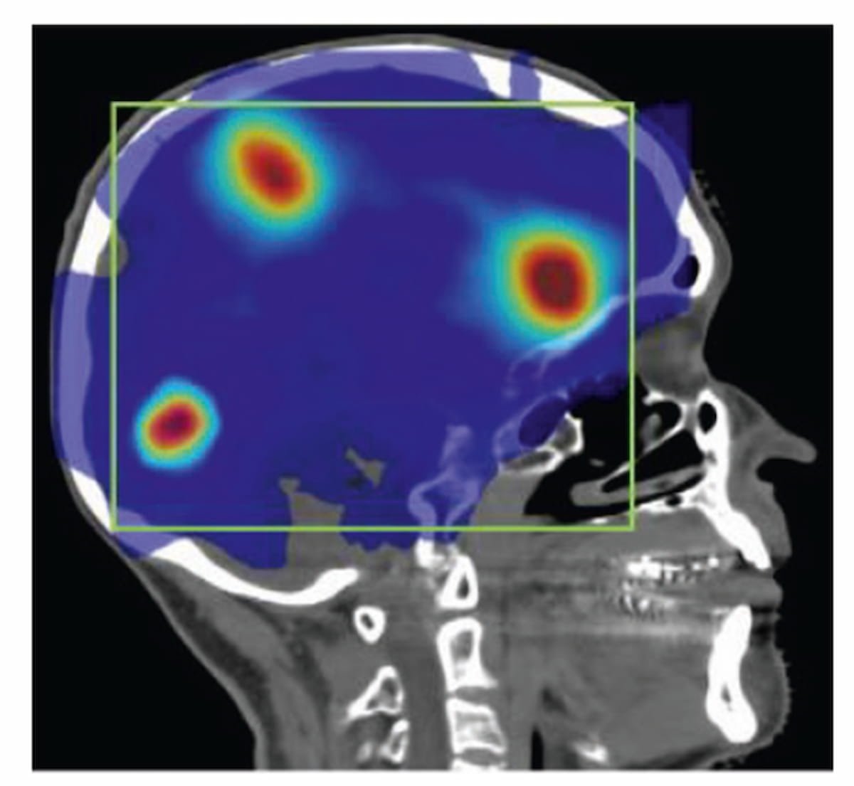 What Does the Future Hold for Brain Imaging and #Radiotherapy? diagnosticimaging.com/view/what-does…
@ACRRFS @ACRYPS @RadiologyACR @ARRS_Radiology @TheASNR @JNeuroradiology @USCneurorads @UCLANeurorads @StanfordRad @UCSFimaging @OHSURadiology @IBADosimetry 
#radiology #RadRes #neuroradiology