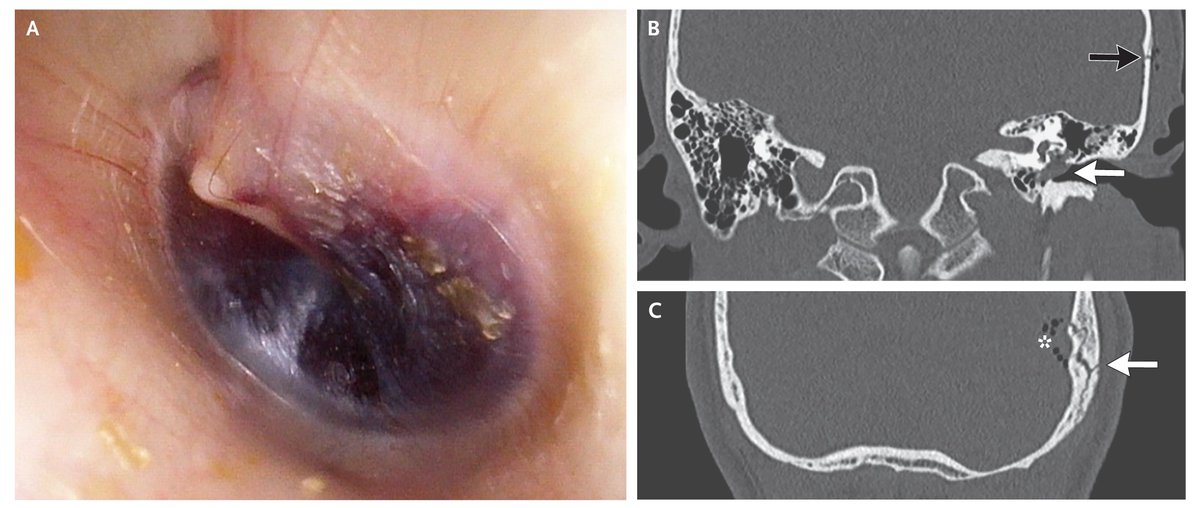 Images in Clinical Medicine: Hemotympanum with a Basilar Skull Fracture nej.md/49OBfhn #EmergencyMedicine