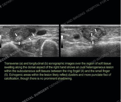 #Orthotwitter – Are you up for a challenge? 49-year-old male with focal painless soft tissue swelling on the dorsum of the right hand. #FOAMrad #MedEd Identify the diagnosis from the teaching files of the #1 hospital in orthopedics: hss.edu/ultrasound-cas…