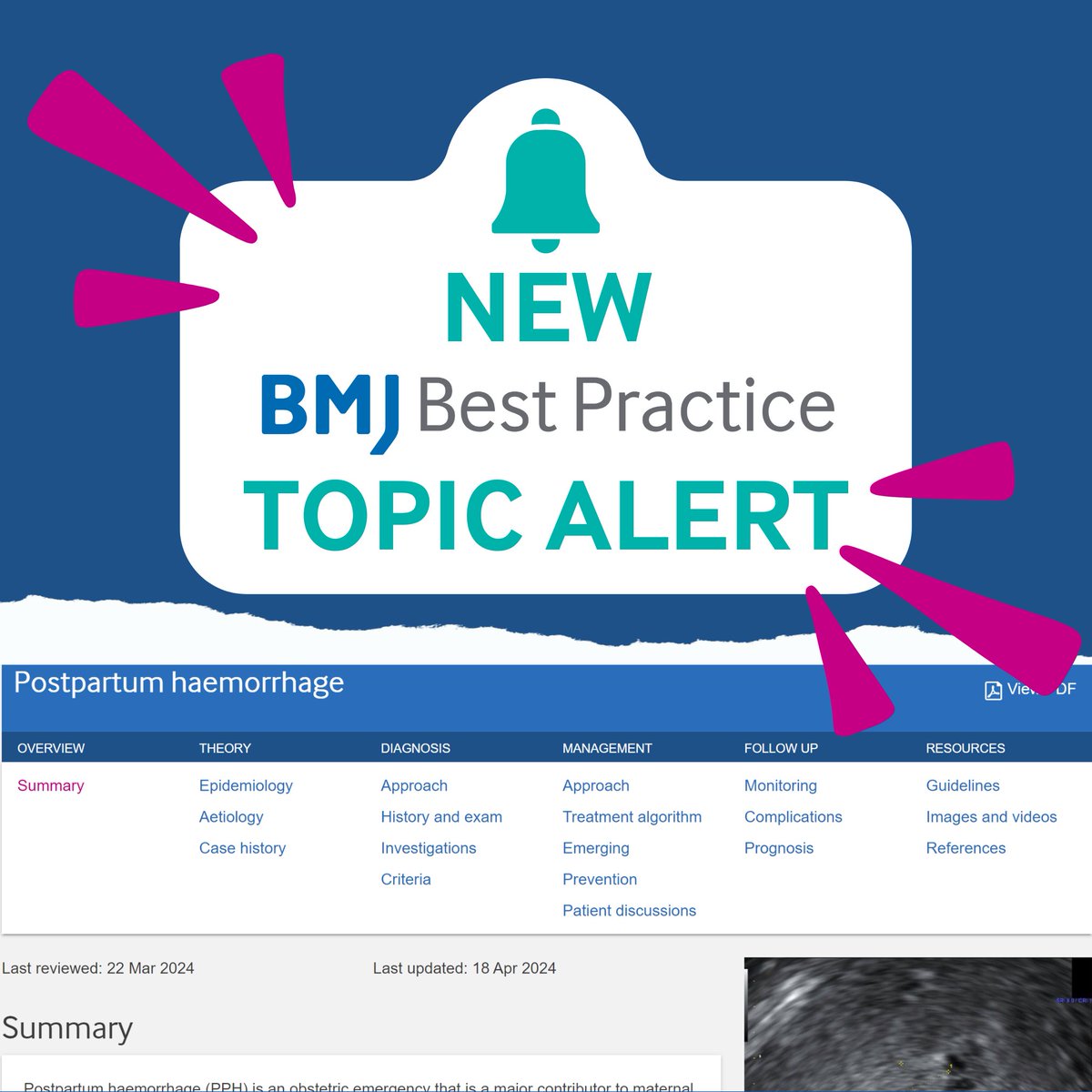 Postpartum haemorrhage is an obstetric emergency. Early recognition relies on accurate quantification of blood loss, together with frequent ongoing assessment of patient-specific risk factors, vital signs, and symptoms of haemorrhage. Read more here> bit.ly/3JueuEE