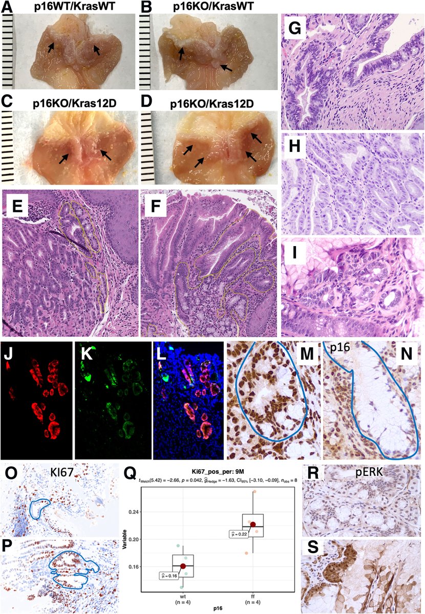 CDKN2A-p16 and oncogenic KRASG12D increase progression of #esophageal Barrett’s-like lesions to pre-cancerous high-grade dysplasia. Want to learn more? Read the article here 🔗ow.ly/uPvx50Rlffn 🖋️@ToniSepulvedaMD