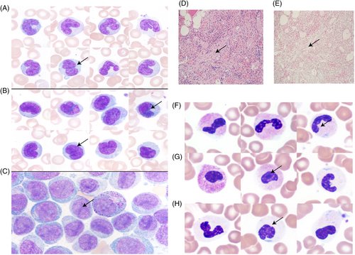 Chronic myelomonocytic leukemia: 2024 update on diagnosis, risk stratification and management |American Journal of Hematology | Blood Research Journal | Wiley Online Library onlinelibrary.wiley.com/doi/10.1002/aj… #cmml #mds