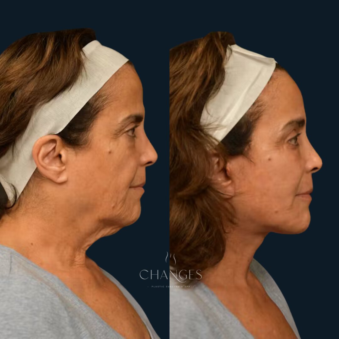 ChangesPlastic's tweet photo. A round of applause for these Changes Rapid lift deep plane facelift results, please! 🤩👏 We can't find an angle we don't love. ✨ 

https://t.co/gVb7VwqzrO https://t.co/RENSZCyI5H