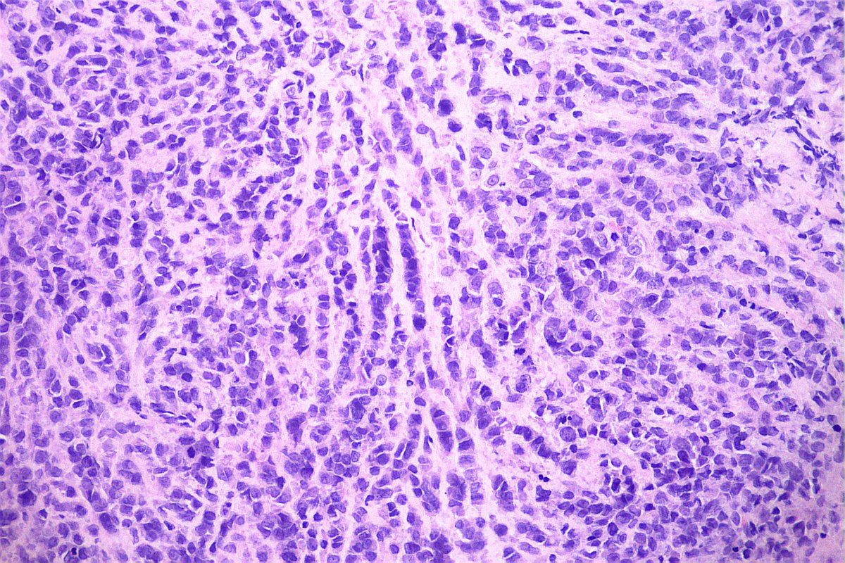 M,30yo. Hand tumor.
IHC marker(s) for Dx?

#bstpath #pathology