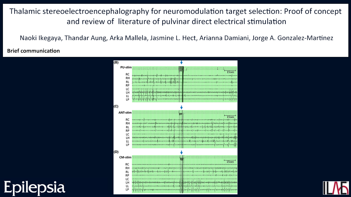 EpilepsiaJourn's tweet photo. Thalamic SEEG for #neuromodulation target selection: Proof of concept and review of literature of pulvinar direct electrical stimulation
https://t.co/K0LOfnDdfZ
#electricalstimulation #epilepsy #pulvinar #SEEG #thalamicstimulation #ILAE @IlaeWeb @epilepsiajourn @WileyNeuro https://t.co/U8sTok0kgN