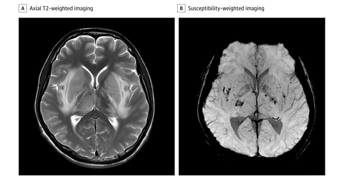 Most viewed in the last 7 days from @JAMANeuro: Case report describes a 17-year-old boy with reduced consciousness and T2-weighted hyperintensity, focal diffusion restriction, and microhemorrhages within the deep gray nuclei and surrounding white matter. ja.ma/3W6nkQw
