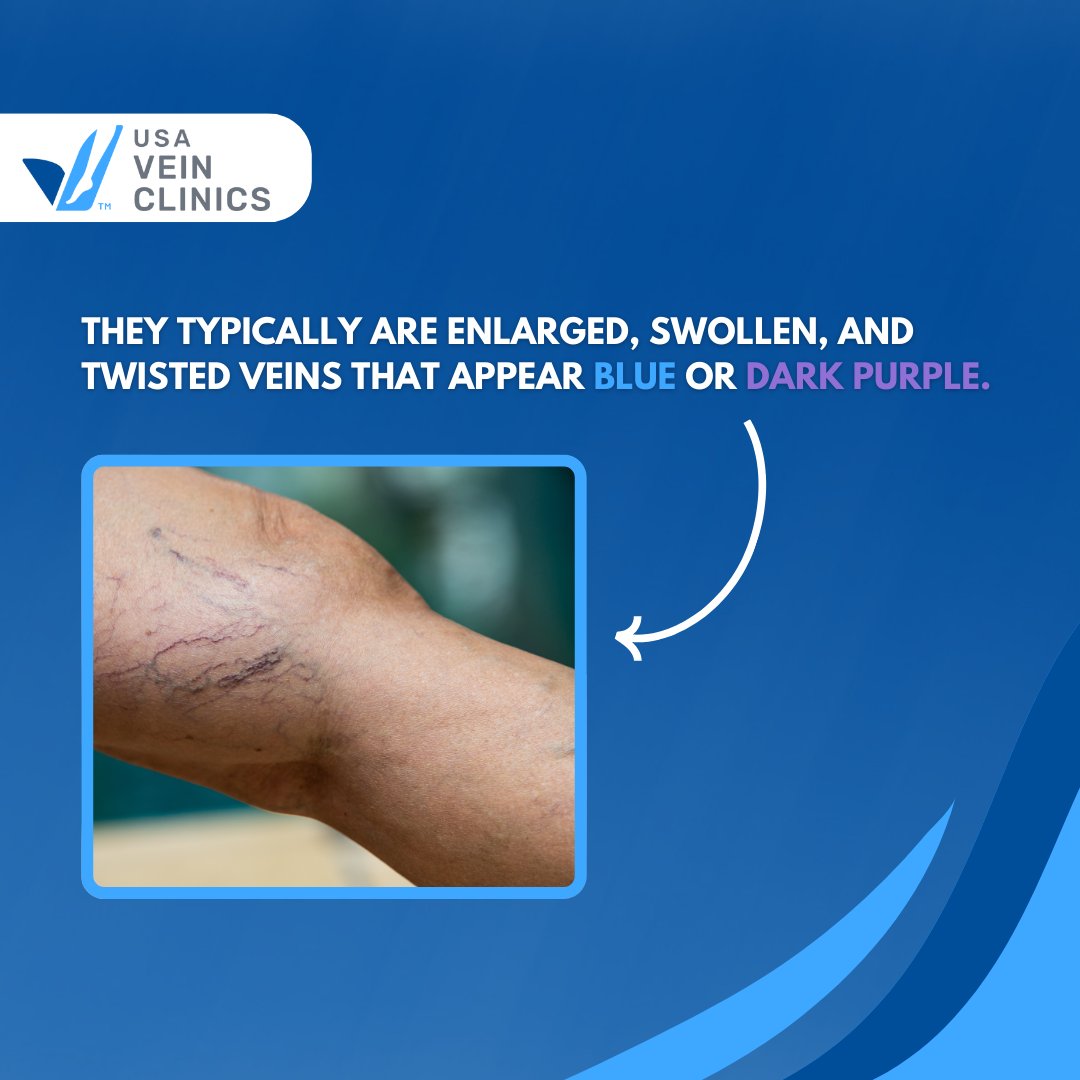usaveinclinics's tweet photo. Struggling with varicose veins? We’re here to help! 🦵💙
👉 Visit our website to schedule an appointment: https://t.co/ReNEoAVyDW
#ScheduleOnline #USAVeinClinics #VeinHealth #VaricoseVeins #VaricoseVeinTreatment #VeinClinic #VeinCare #LegHealth #VeinIssues #ScheduleNow #EVLT https://t.co/a2zyNvf2qS