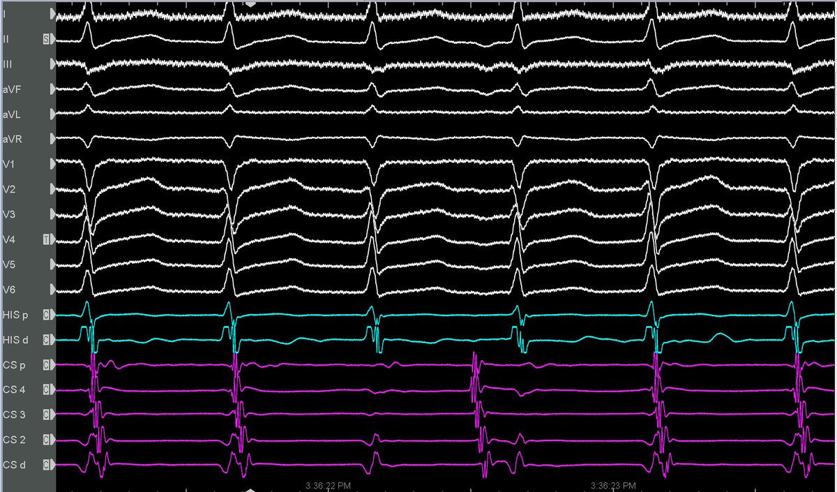 ''How many 'pathways' there are ?'' @Mkara_EP @mharman2320 @IMerovci @SerhatKocadr @ElifhandeMD @AhmetKorkmaz07A @DuyguKocyigitMD @iremdilaracan @drfiratozcan @prof_serkan_cay @ozcanozeke @drtuncez @DursunAras2 @topaloglu_prof @KakkamKrishna @GeorgeKleinMD