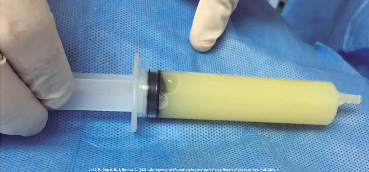 Chylotorax: Accumulation of chyle in the pleural cavity. From the Greek “Chylos” which means juice.

• Pleural fluid triglycerides > 110 mg/dL or presence of chylomicrons
• Appearance can be milky white, serous, or serosanguineous
• Trauma and malignancy are the leading causes