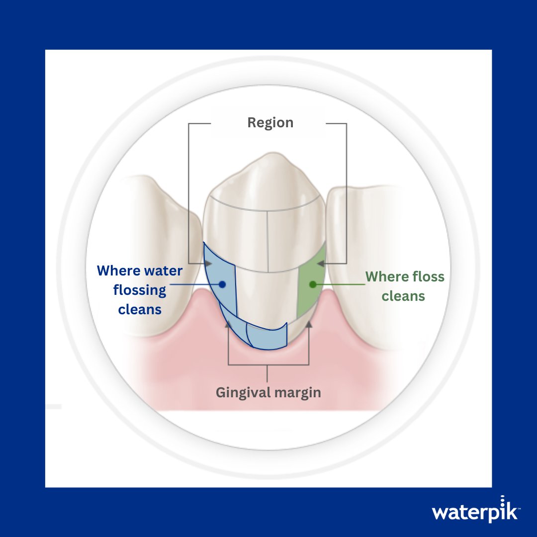 Waterpik water flossers are clinically proven to clean deep between teeth and under the gumline where traditional brushing and string flossing can't reach. That's pretty amazing! 🤩 #Waterpik #WaterFlosser #OralCare #DentalHealth #HealthySmile #DentalHygiene #GumHealth