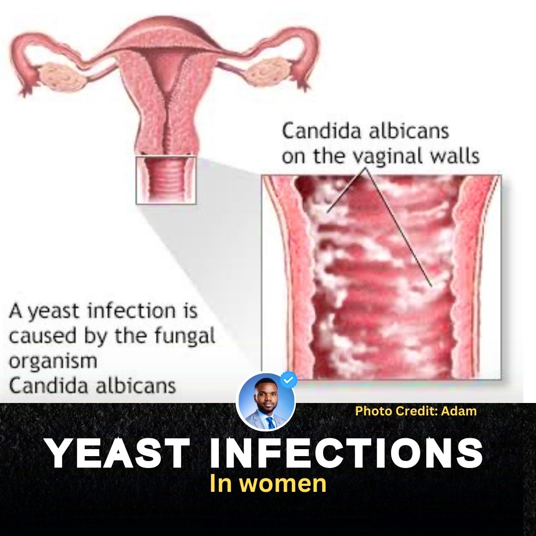 Yeast infections do not need antibiotics 
Yeast is fungi, hence a fungal infection 

You may have approached this wrongly,

Let me explain yeast infections to you, especially the ladies

A thread