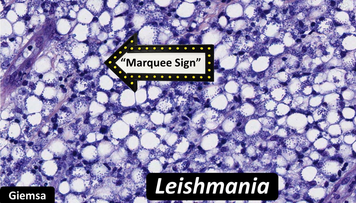 Leishmaniasis is caused by a protozoan parasite
Transmitted by sandflies
Dermal histiocytes show cytoplasmic vacuoles containing a rim of tiny organisms, the Marquee sign.
✅Protozoa. Fungus is also acceptable since Histoplasma yeasts are about the same size as Leishmania