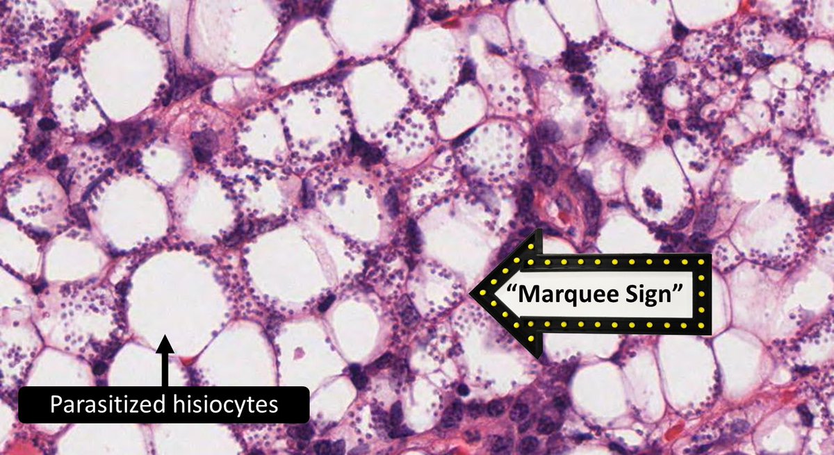DrCycloPath's tweet photo. Parasitized histiocytes. What kind of parasite?
A) bacteria
B) fungus
C) protozoa
D) virus
#dermpath #pathtwitter #crittersontwitter #pathology #pathbugs https://t.co/KOkUD3XBGD