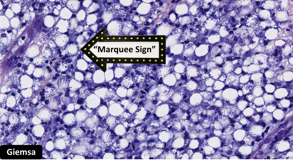 DrCycloPath's tweet photo. Parasitized histiocytes. What kind of parasite?
A) bacteria
B) fungus
C) protozoa
D) virus
#dermpath #pathtwitter #crittersontwitter #pathology #pathbugs https://t.co/KOkUD3XBGD