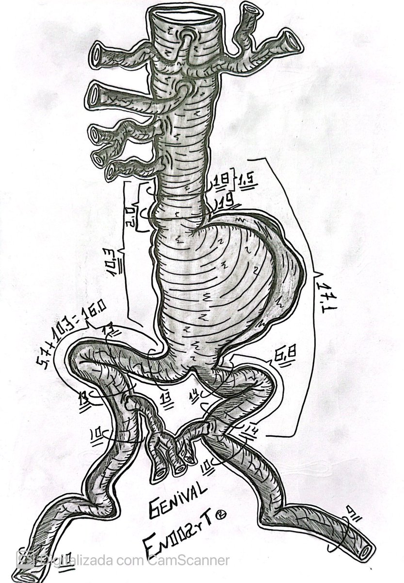 AAA neck with 1.5 Fusiform.
@AortaSurg @MarchandSurgery @Aortaed #aortaEd #AortaEd @mvborges @JxnxsFlores