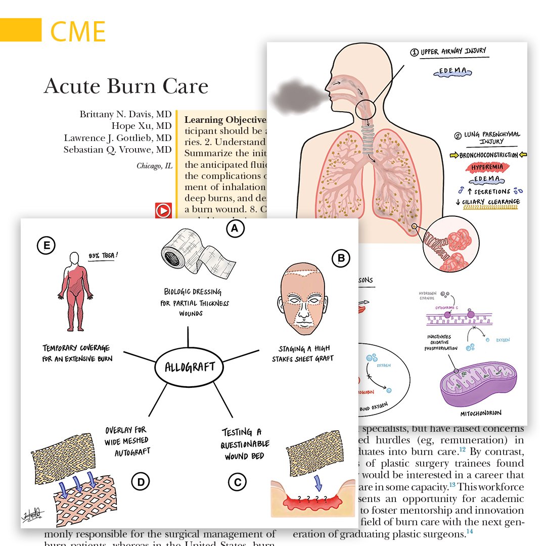 Read and learn about how to perform a wound assessment, calculate the anticipated fluid resuscitation requirements for a #burninjury, perform excision of a #burnwound, and more: bit.ly/AcuteBurnCME