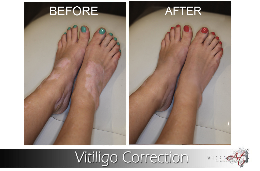 MicroArt is the ultimate safe and effective treatment for Vitiligo without any side effects and does not trigger Vitiligo to spread. Cutting-edge equipment, custom pigment colors, and results so natural that no one can tell you ever had Vitiligo.

#microart #vitiligo #pmu